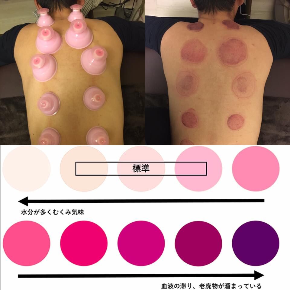✨カッピング始めました✨