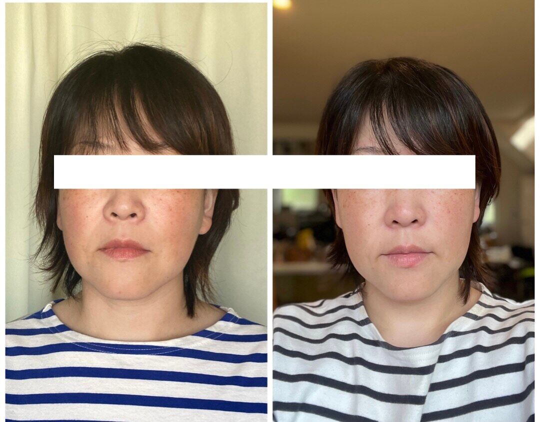 【魔法の小顔矯正】Before After