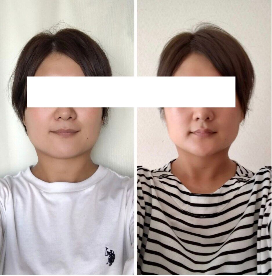 エラ張りもお任せあれ【魔法の小顔矯正】Before After
