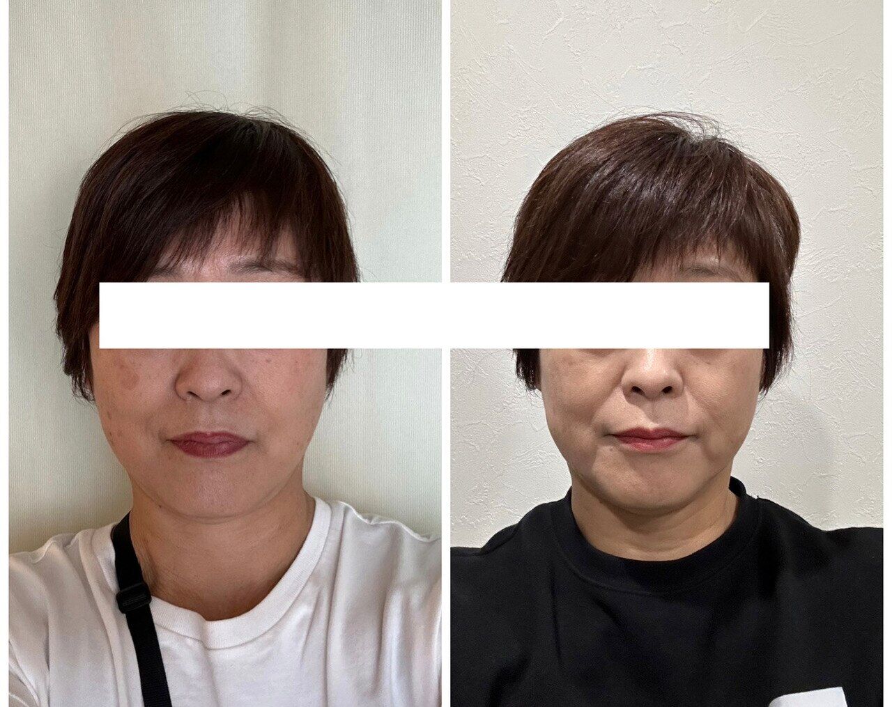 魔法の小顔矯正 Before After