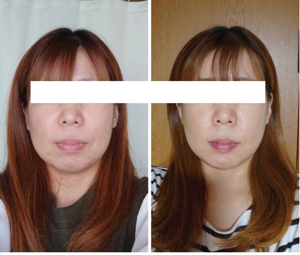 魔法の小顔矯正 Before After