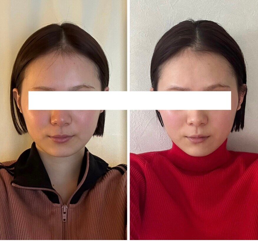 【魔法の小顔矯正】Before After