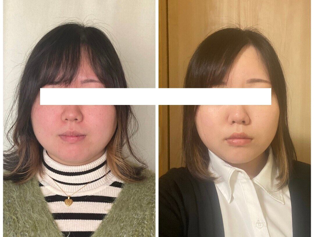 【魔法の小顔矯正】Before After