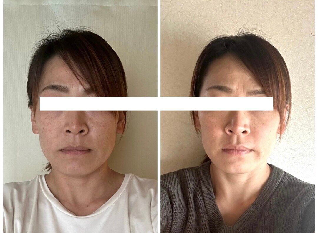 魔法の小顔矯正 Before After