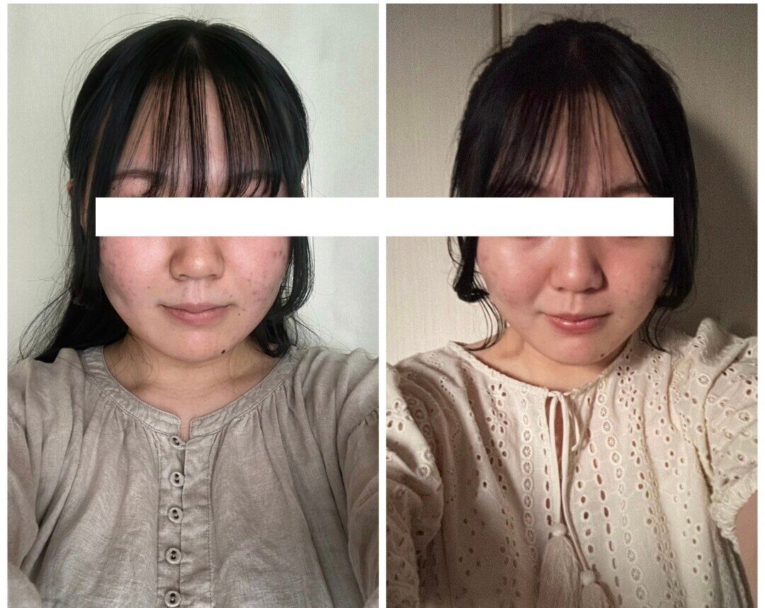 【魔法の小顔矯正】Before After