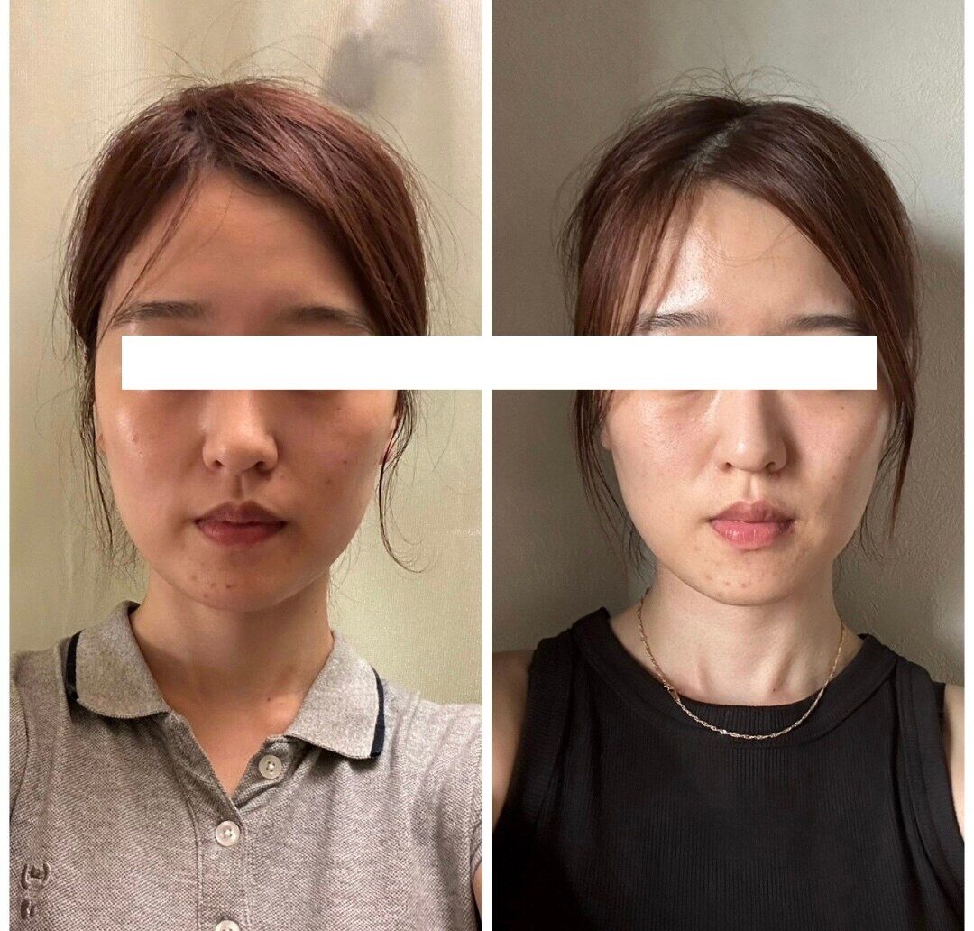 【魔法の小顔矯正】Before After
