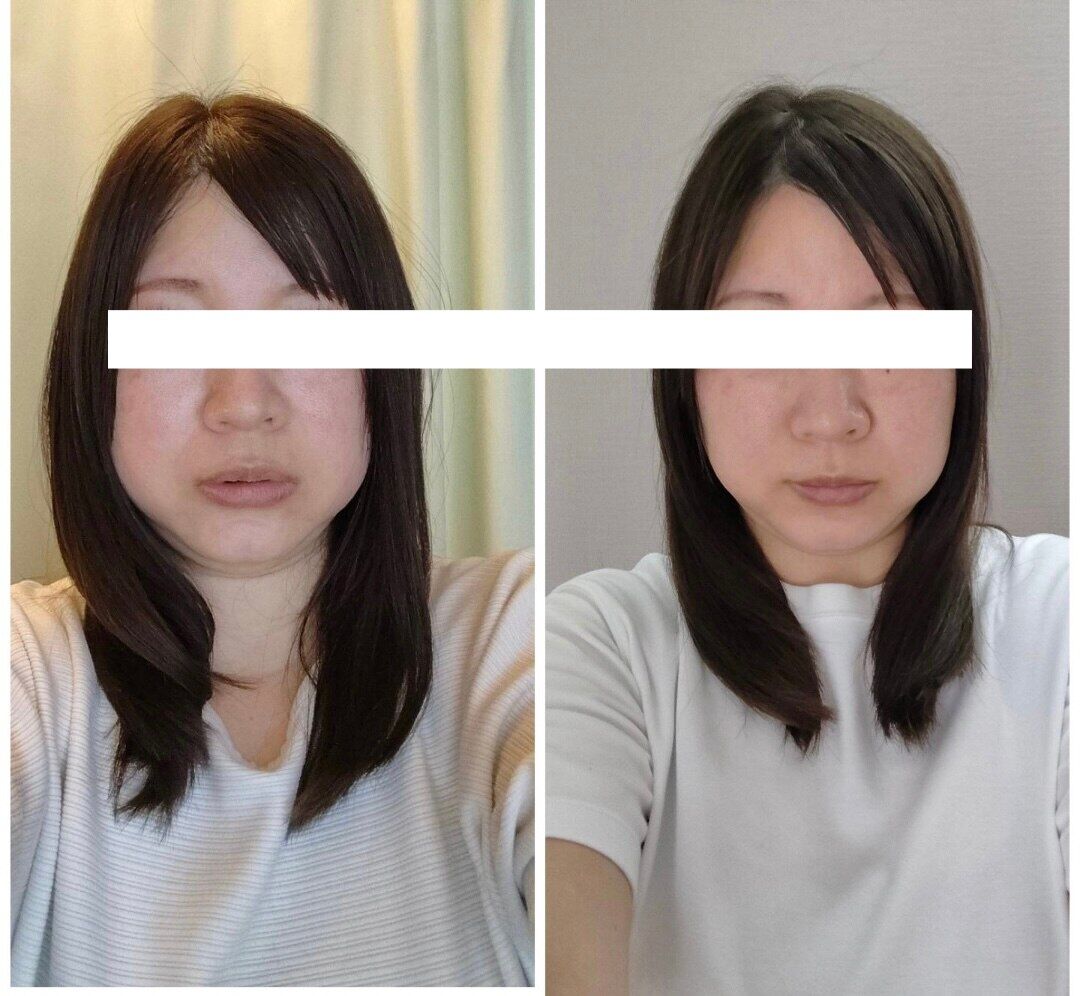 一目瞭然の小顔効果！【魔法の小顔矯正】Before After