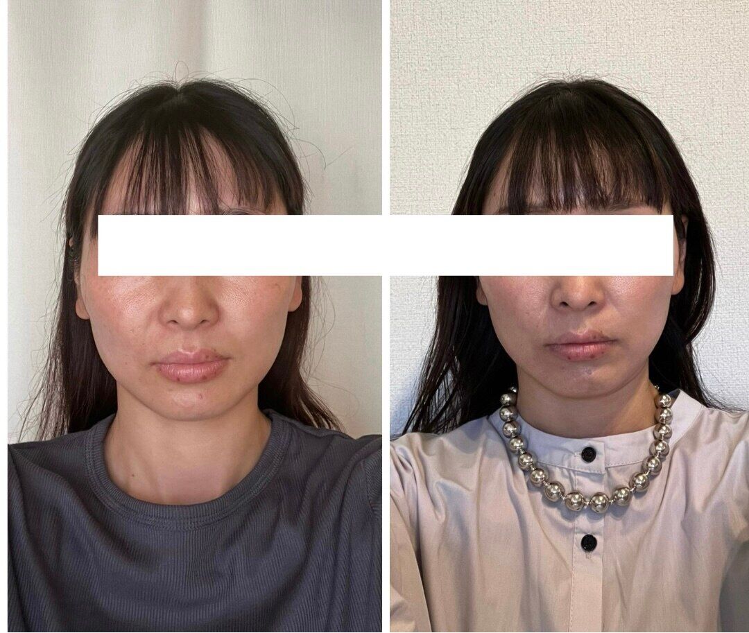 【魔法の小顔矯正】Before After